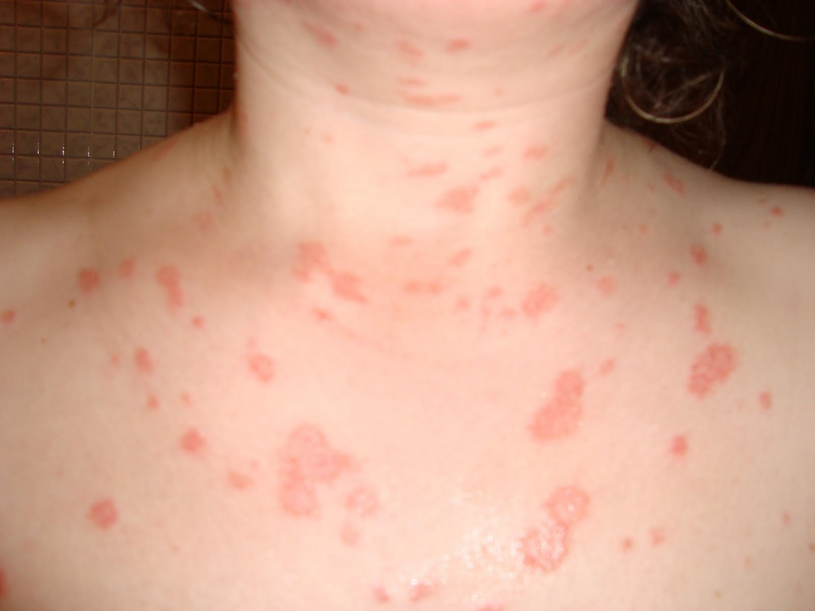 Ante OMS Panamá lidera solicitud de incluir psoriasis como enfermedad grave